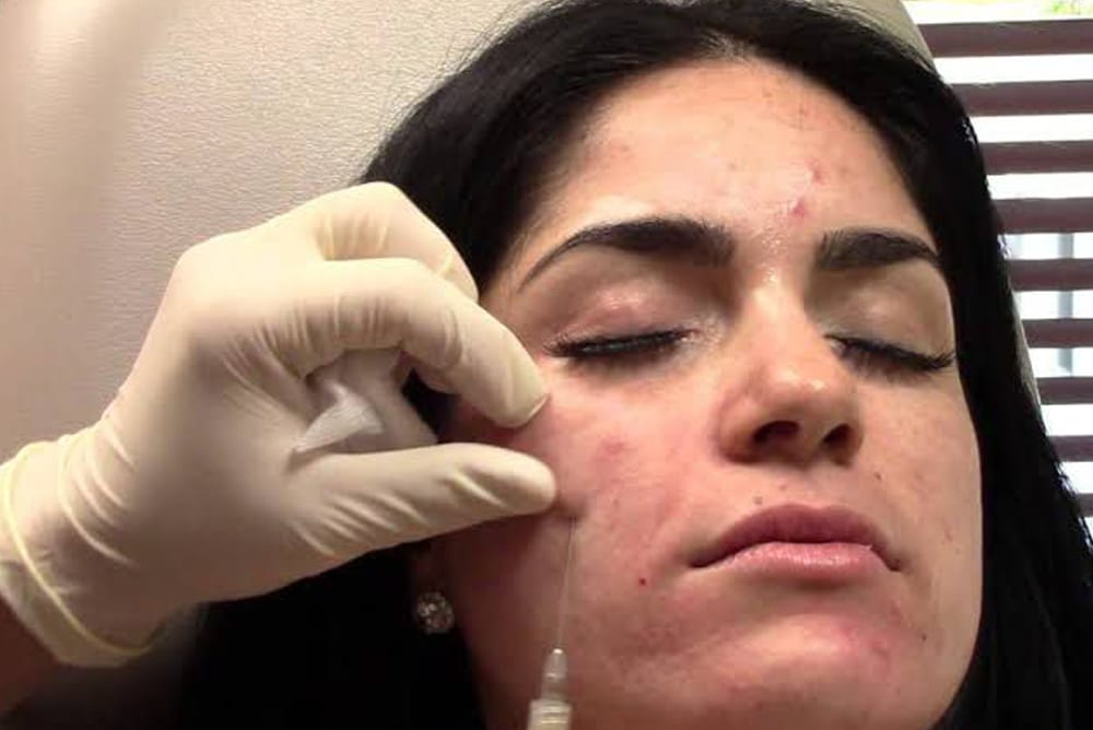 PRP-for-Acne-1000x668
