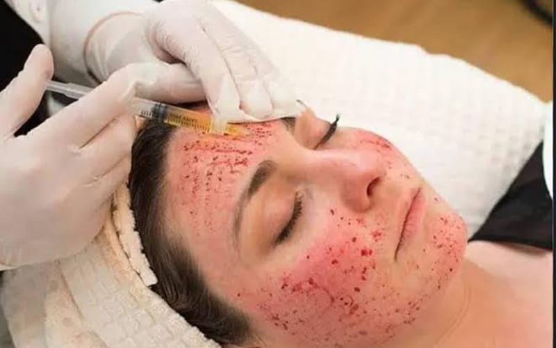 Vampire-Facial